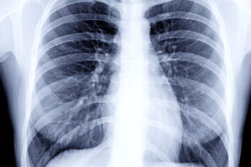 छातीमा देखिने दाग भनेको के हो ? जान्नुहोस्